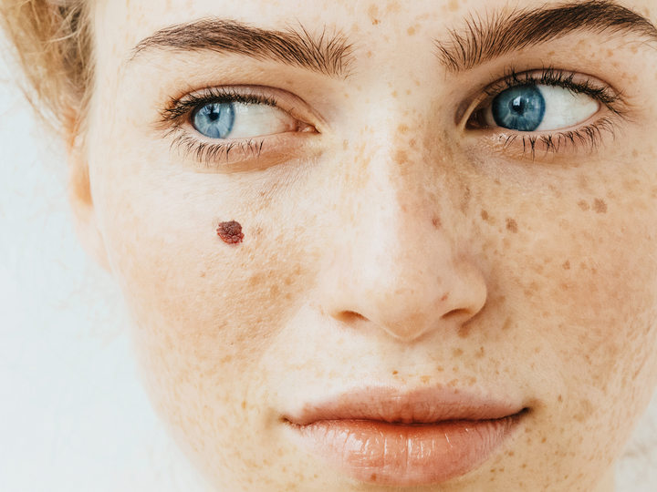 Spolu proti melanomu: Nechte si zdarma vyšetřit mateřská znaménka