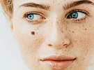 Spolu proti melanomu: Nechte si zdarma vyšetřit mateřská znaménka